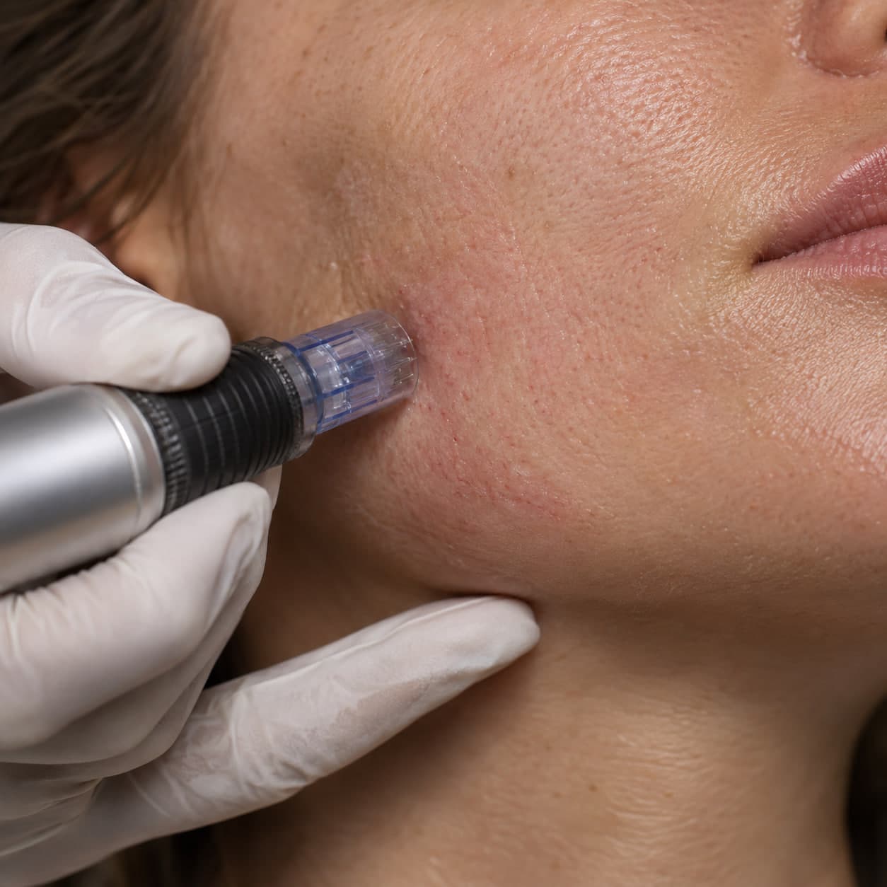 Professional microneedling treatment on the cheek at Budapest Skincare